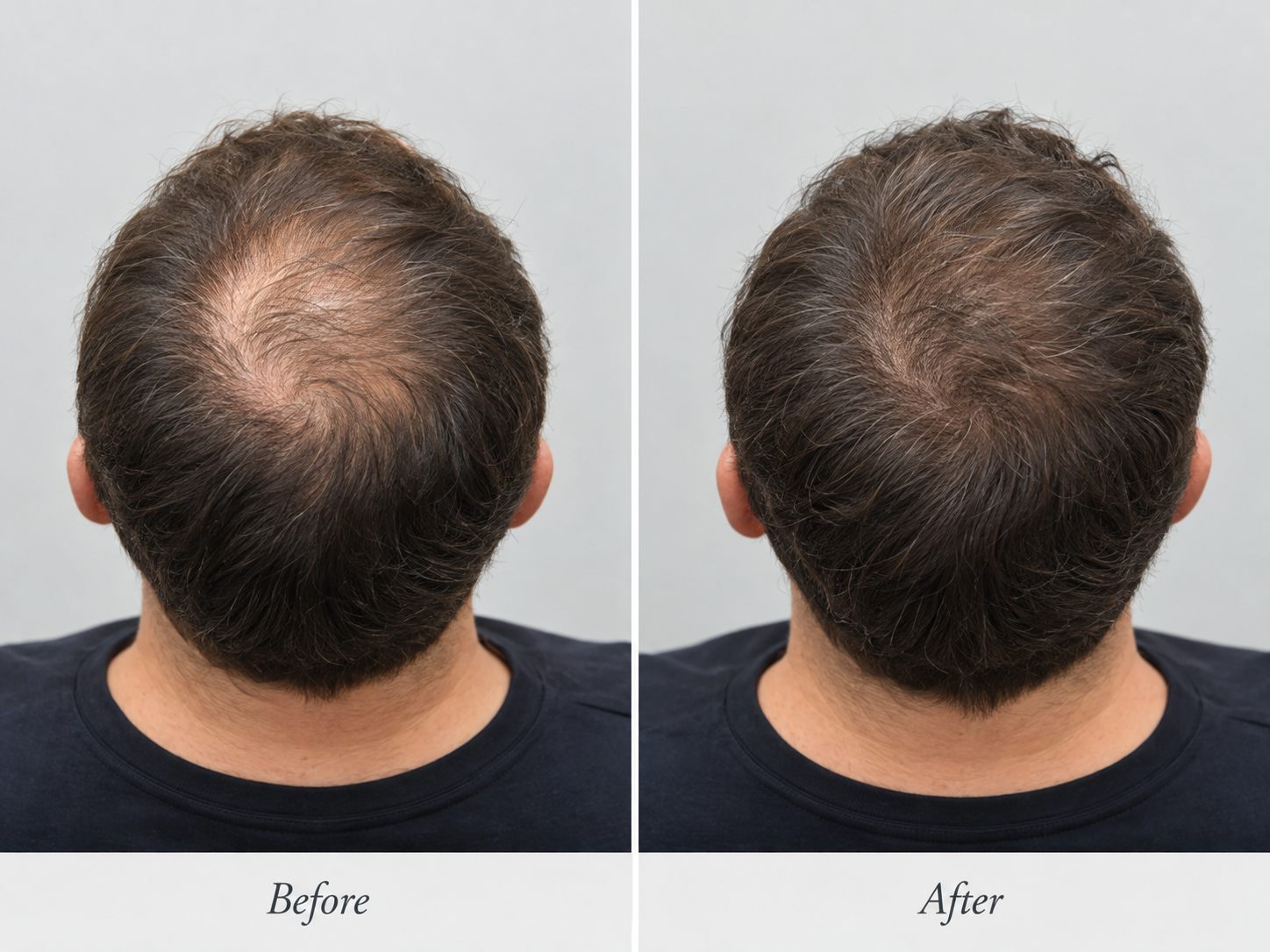 Illustratives Vorher-Nachher-Beispiel einer Haartransplantation – Oberkopfansicht